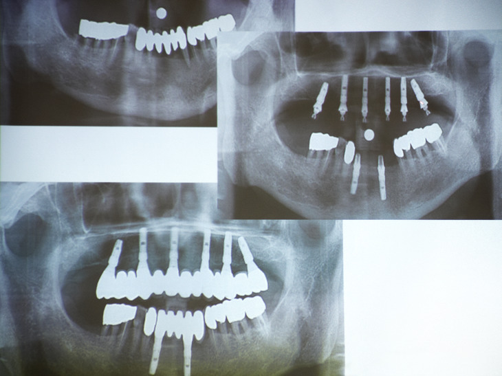 Необходимые снимки перед имплантацией зубов